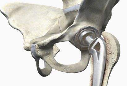 股骨头坏死的病因涉及哪些方面